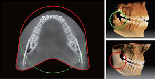 Hình ảnh chụp từ CBCT PaX-i3D Smart với diện tích lớn hơn, thấy được cả răng ngầm