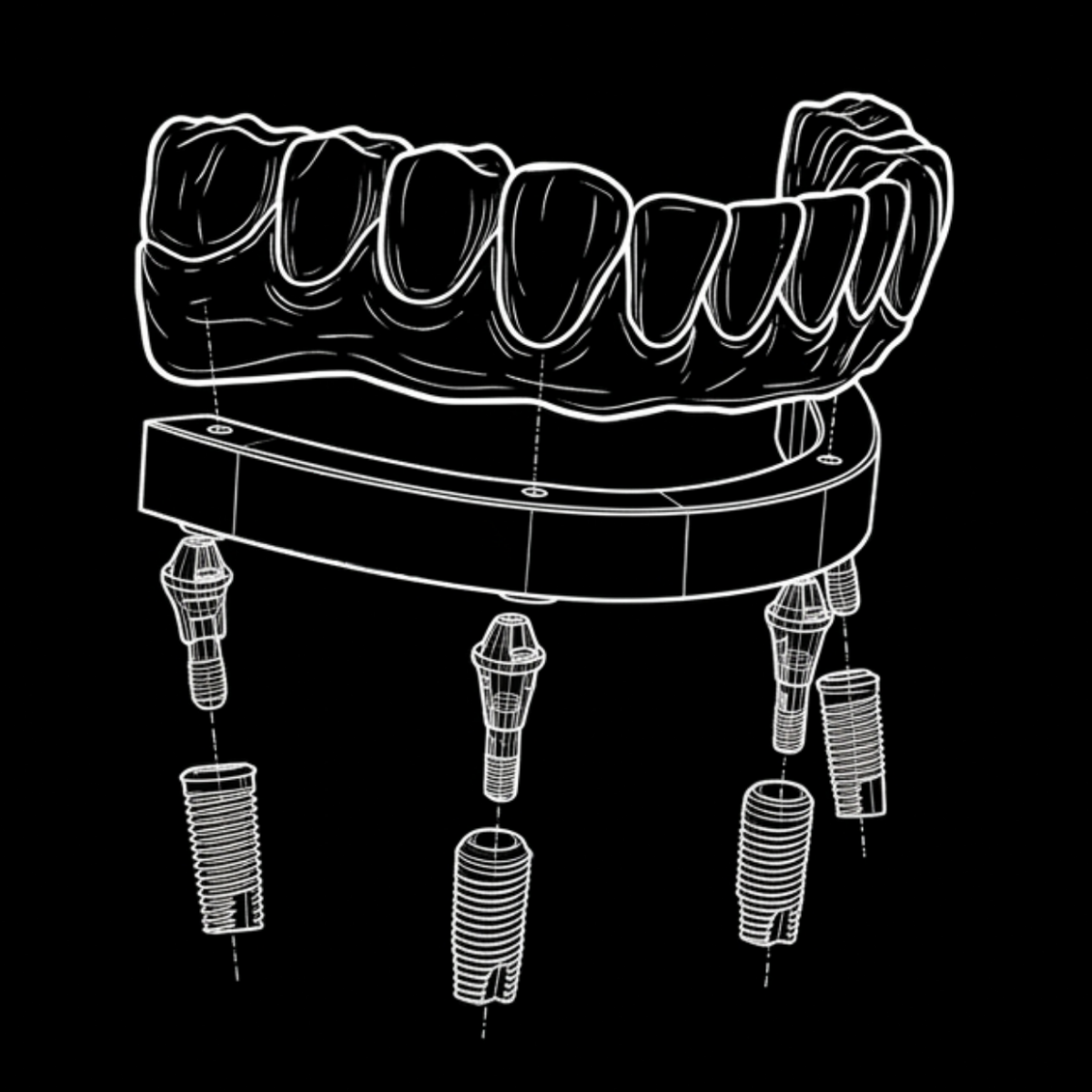 GIẢI PHÁP IMPLANT
